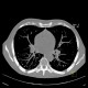 Calcifications in lung parenchyma, vasculitis: CT - Computed tomography